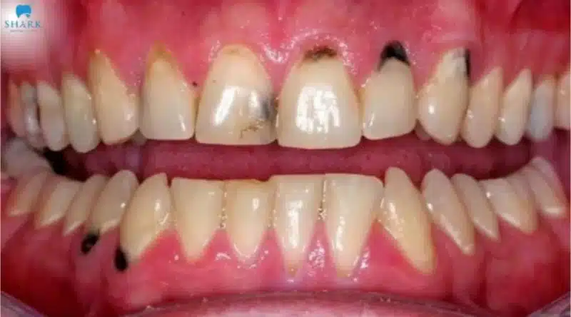 Minh họa hình ảnh sâu răng nanh
