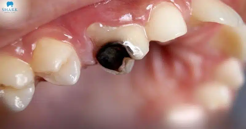 Hình ảnh sâu răng nặng ở vị trí răng số 4