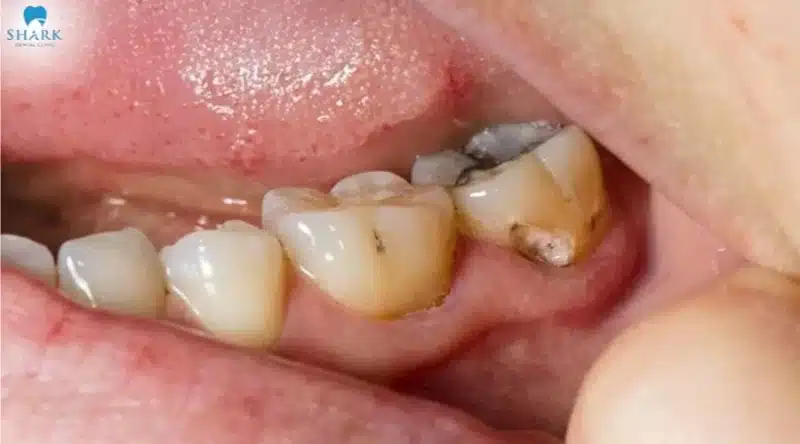 Răng hàm lớn bị sâu gây ảnh hưởng đến chức năng ăn nhai và kéo thêm nhiều vấn đề răng miệng khác