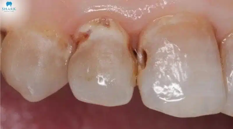 Sâu răng bề mặt là một dạng tổn thương răng thường gặp ở nhiều độ tuổi
