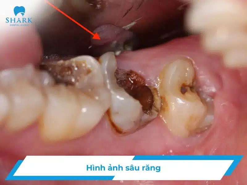 Hình ảnh sâu răng