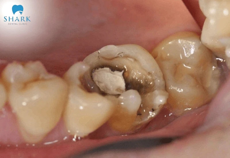 Tuỷ răng bị hoạt tử