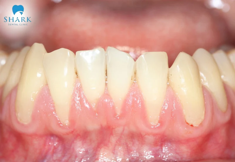 Lợi không bám vào chân răng