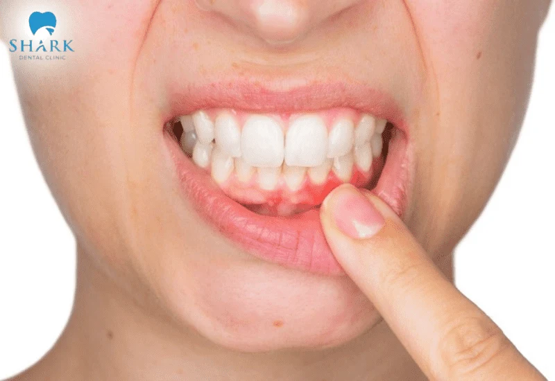 Lợi hở chân răng