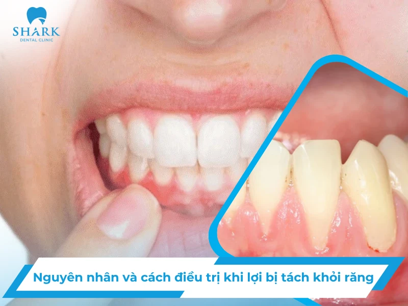 Nguyên nhân và cách điều trị khi lợi bị tách khỏi răng 13 Lợi bị tách khỏi răng