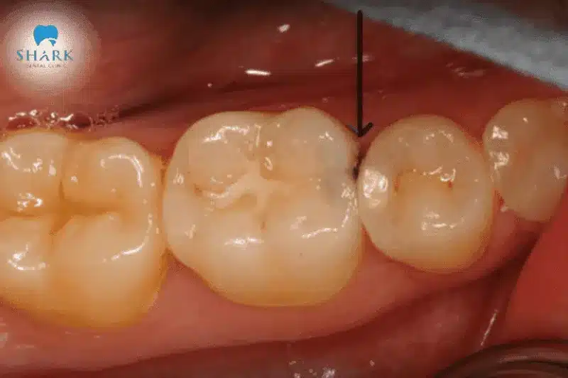 Vết trám răng bị đen gây mất thẩm mỹ răng miệng