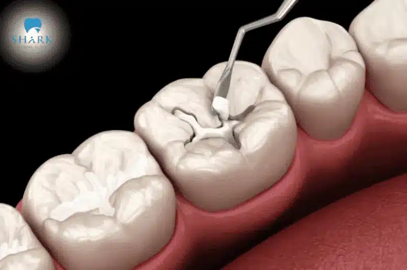 Kỹ thuật trám răng là nguyên nhân khiến miếng trám bị đen