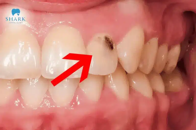 Sâu răng tái phát làm vết trám răng bị đen