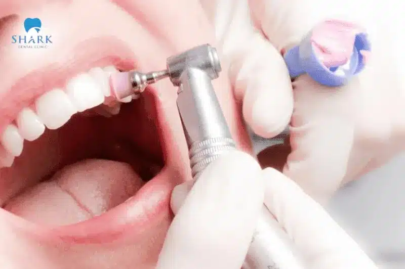 Đánh bóng răng là cách nhanh chóng khôi phục miếng trám răng bị 