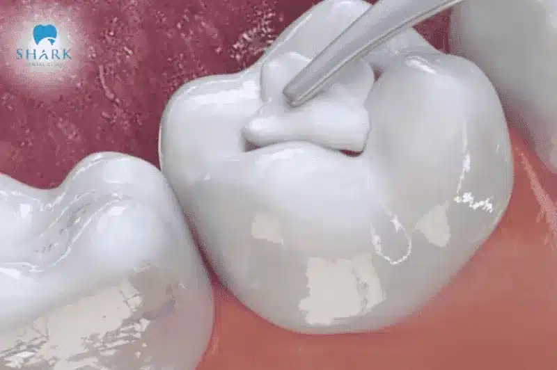 Thay miếng trám răng mới giúp răng chắc khỏe và sáng đẹp hơn