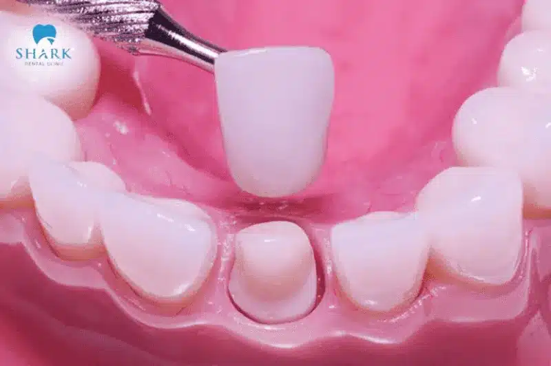 Bọc răng sứ giúp duy trì độ bền và màu sắc lâu dài