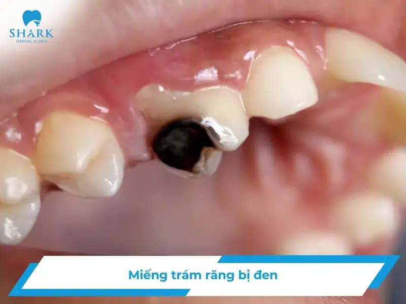 Miếng trám răng bị đen có sao không?