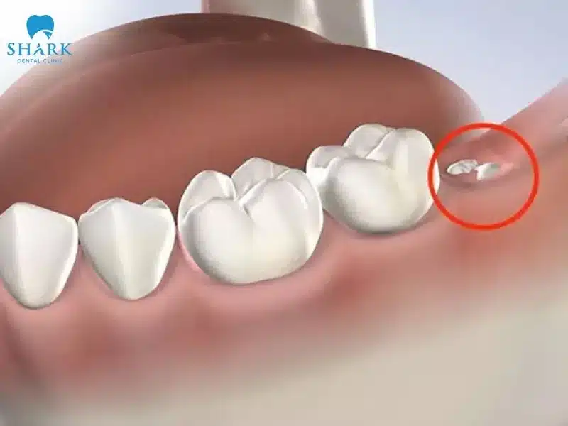 Mọc răng khôn có ý nghĩa gì? Ý nghĩa tốt hay xấu? 4 Mọc răng khôn là điềm báo về tài lộc và may mắn
