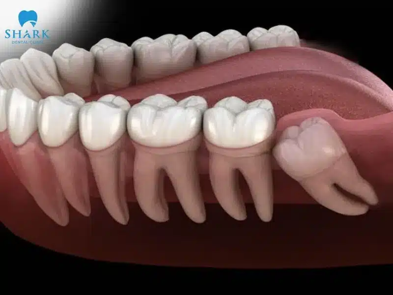 Mọc răng khôn có ý nghĩa gì? Ý nghĩa tốt hay xấu? 5 Những điều không may khi răng khôn mọc lệch
