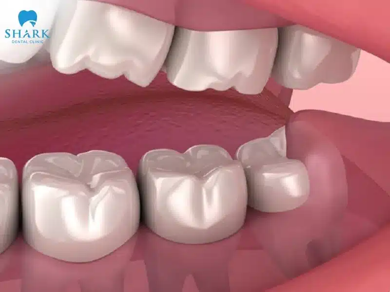 Mọc răng khôn có ý nghĩa gì? Ý nghĩa tốt hay xấu? 6 Răng khôn mọc thẳng là chiếc răng khôn may mắn