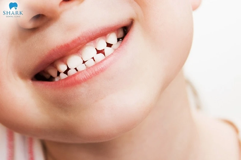 Có nên nhổ răng sữa khi chưa lung lay không, còn tùy thuộc vào từng tình trạng răng của trẻ