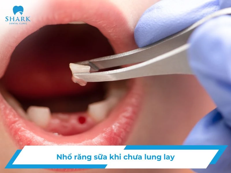 Nhổ răng sữa khi chưa lung lay