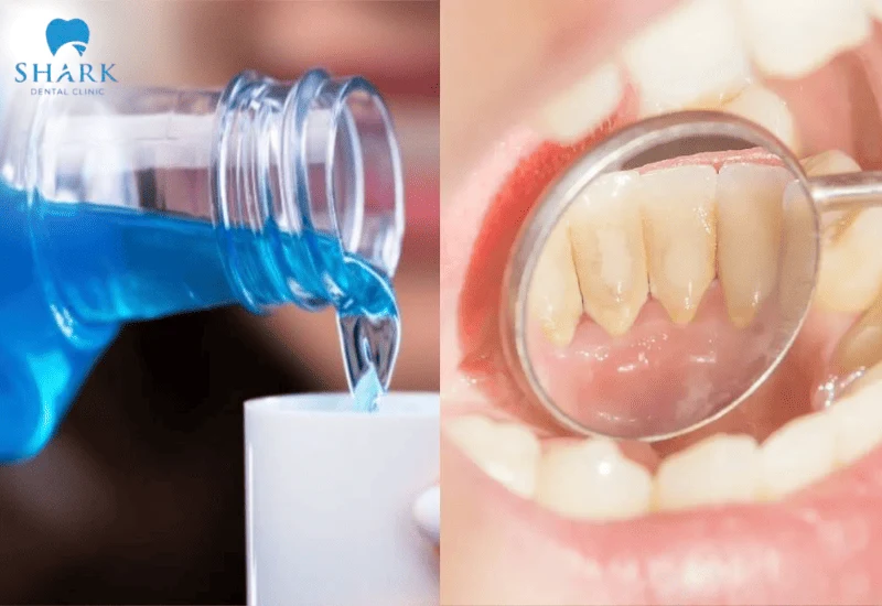 Giải đáp: Nước súc miệng lấy cao răng có hiệu quả không? 5 Nước súc miệng không lấy cao răng được