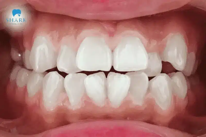 Bác sĩ giải đáp: Răng khấp khểnh có bọc sứ được không? 9 Răng khấp khểnh gây ảnh hưởng đến thẩm mỹ và khả năng ăn nhai