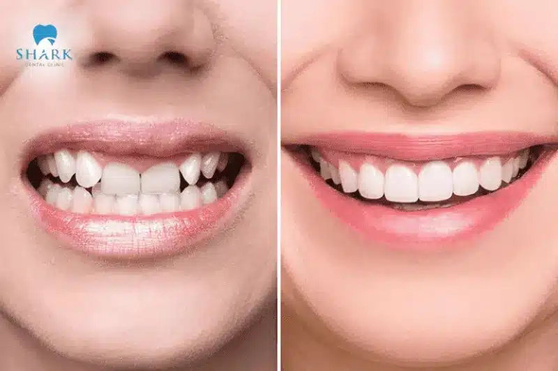 Bác sĩ giải đáp: Răng khấp khểnh có bọc sứ được không? 12 Bọc sứ răng khấp khểnh giúp răng trắng sáng, đều màu