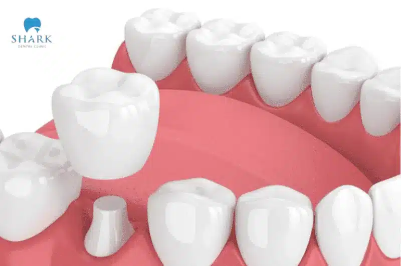 Bác sĩ giải đáp: Răng khấp khểnh có bọc sứ được không? 13 Chi phí bọc sứ tùy thuộc vào từng loại răng sứ khác nhau