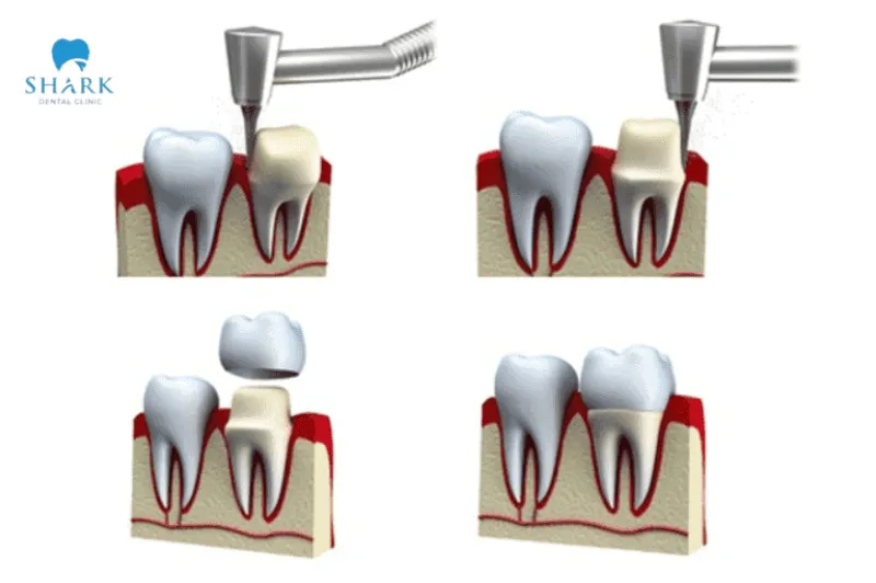 Bác sĩ giải đáp: Răng khấp khểnh có bọc sứ được không? 14 Bọc sứ cho răng khấp khểnh được đảm bảo thực hiện theo quy trình chuẩn