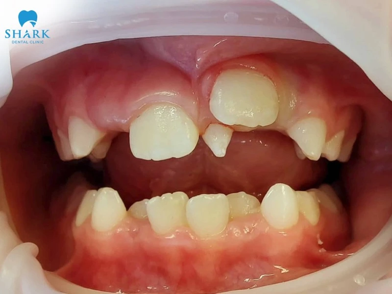 Răng mọc ngược là gì? Có nguy hiểm hay không? 7 Răng phát triển ngược có thể gây ra các bệnh lý về răng miệng