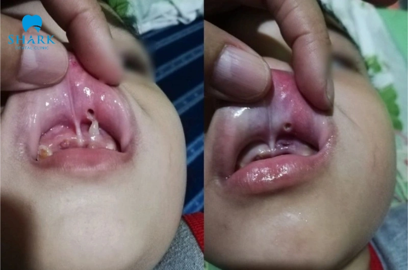 Răng mọc ngược là gì? Có nguy hiểm hay không? 6 Răng mọc ngược đâm vào môi trên