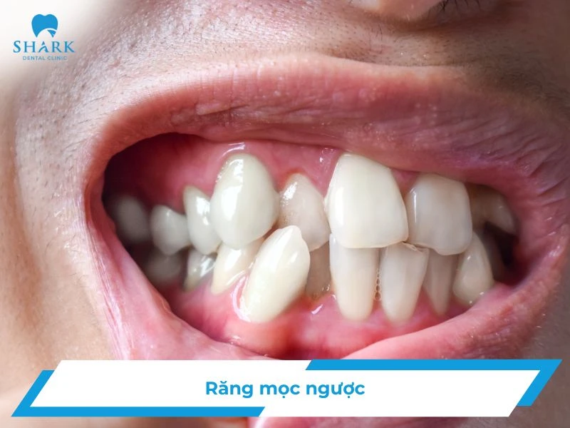Răng mọc ngược