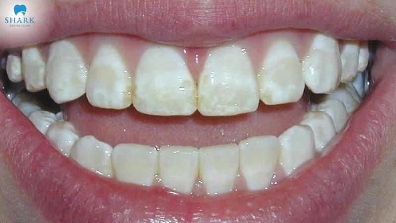 Tại sao răng trẻ bị trắng đục? Cách để xử lý hiệu quả 6 Nhiễm fluor là nguyên nhân phổ biến khiến cho nhiều trẻ bị trắng đục ở răng