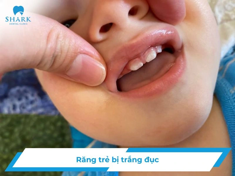 Răng trẻ bị trắng đục