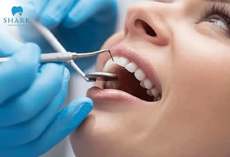Tác hại của việc trám răng và cách phòng tránh hiệu quả 7 Trám răng sai kỹ thuật dễ làm vi khuẩn lan rộng, gây hại cho răng bên cạnh.