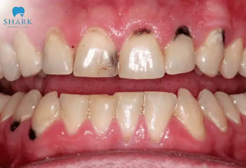 Tác hại của việc trám răng và cách phòng tránh hiệu quả 9 Trám răng sai kỹ thuật có thể để lại vết đen trên răng và nướu