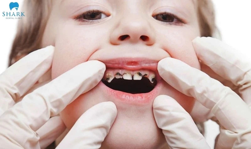 Trẻ bị sâu răng ăn vào tủy: Nguyên nhân, dấu hiệu và quy trình điều trị 8 Trẻ bị sâu răng ăn vào tuỷ