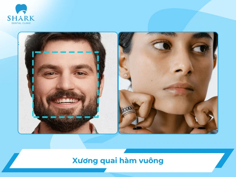 Xương quai hàm vuông: Nguyên nhân và cách khắc phục hiệu quả 17 Xương quai hàm vuông