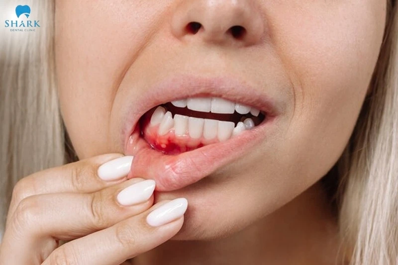 Chảy máu chân răng không cầm được cần phải làm gì? 6 Chảy máu chân răng liên tục không cầm được có thể bắt nguồn từ một số vấn đề tiềm ẩn của cơ thể