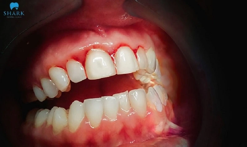 Chảy máu chân răng không cầm được cần phải làm gì? 8 Chảy máu chân răng không cầm máu nếu kéo dài mà không điều trị sẽ ảnh hưởng nghiêm trọng đến sức khoẻ