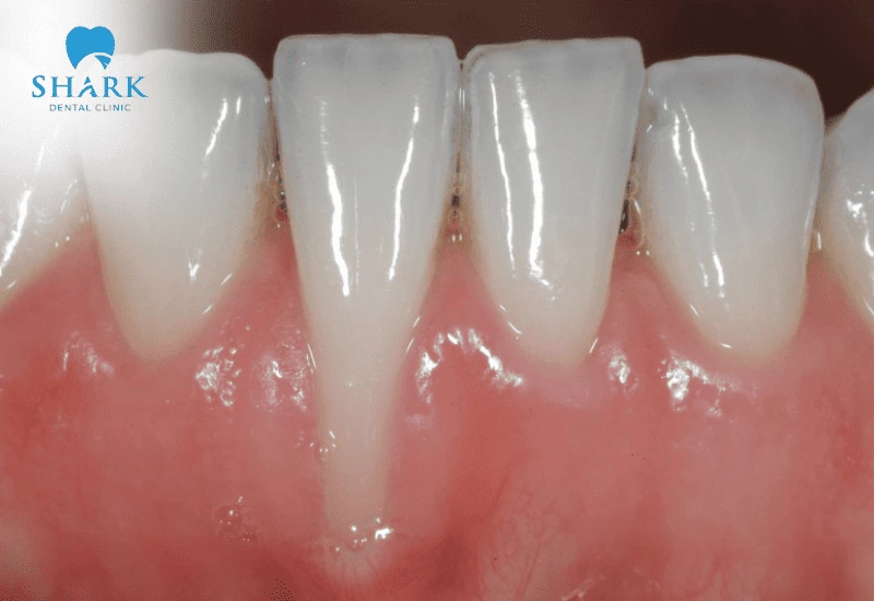 Chữa tụt lợi giá bao nhiêu tiền? Giá điều trị lợi tháng 11/2025 9 Tụt lợi khiến chân răng lộ rõ, dài hơn bình thường