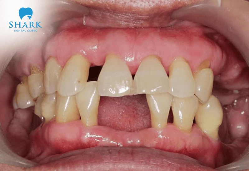 Chữa tụt lợi giá bao nhiêu tiền? Giá điều trị lợi tháng 11/2025 11 Tụt nướu nghiêm trọng gây mất răng nếu không điều trị sớm