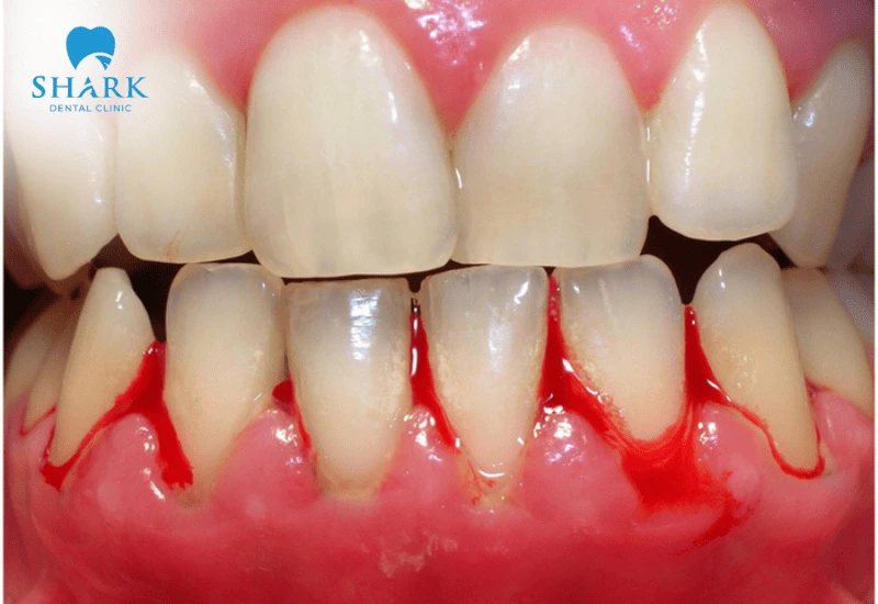 Chữa tụt lợi giá bao nhiêu tiền? Giá điều trị lợi tháng 11/2025 13 Tùy vào từng tình trạng tụt lợi mà chi phí cũng khác nhau