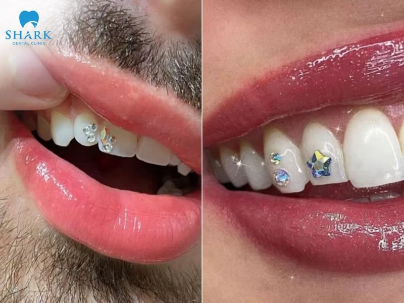 Đính đá lên răng là gì? Giá gắn đá vào răng bao nhiêu tiền? 7 Đính đá lên răng được giới trẻ ưa chuộng hiện nay