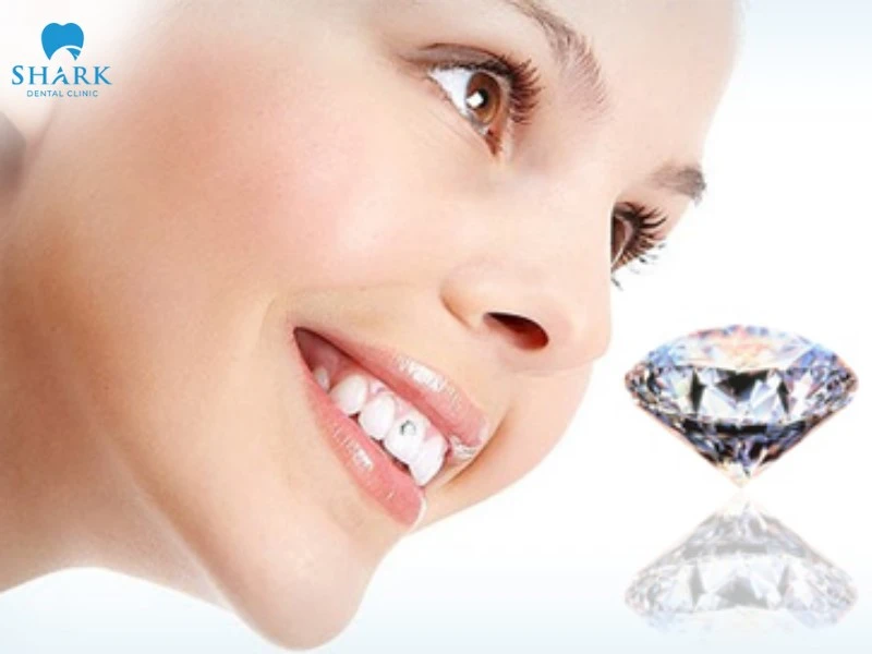 Đính đá lên răng là gì? Giá gắn đá vào răng bao nhiêu tiền? 8 Đính đá lên răng mang đến nụ cười rạng rỡ, lấp