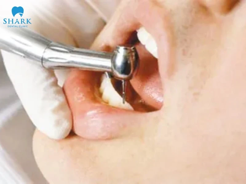 Đính đá lên răng là gì? Giá gắn đá vào răng bao nhiêu tiền? 9 Đính đá lên răng bằng phương pháp khoan lỗ gây tổn thương men răng