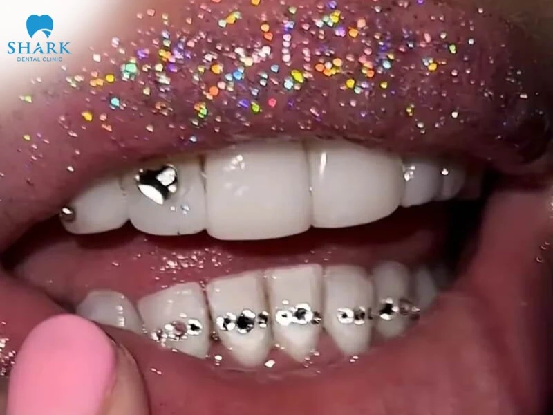 Đính đá lên răng là gì? Giá gắn đá vào răng bao nhiêu tiền? 11 Đính đá lên răng với các viên đá hình trái tim ở răng cửa kết hợp hàng đá nhỏ ở răng dưới, cùng son môi ánh nhũ, tạo hiệu ứng lấp lánh và phong cách cá tính