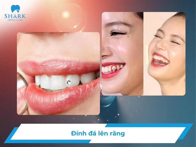Đính đá lên răng