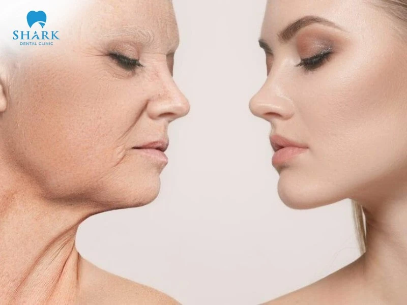 Tuổi tác khiến da dần mất đi độ săn chắc, khiến đường viền hàm trở nên kém rõ nét và chảy xệ