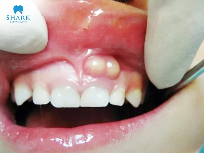 Tất tần tật về nang chân răng và phương pháp điều trị hiệu quả 7 Nhiễm trùng nang chân răng