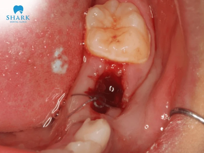Tất tần tật về nang chân răng và phương pháp điều trị hiệu quả 8 Mất răng vĩnh viễn do nang chân răng