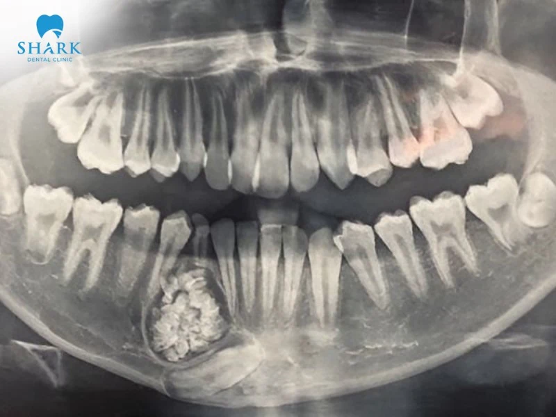 Tất tần tật về nang chân răng và phương pháp điều trị hiệu quả 9 Nang răng có kích thước nhỏ