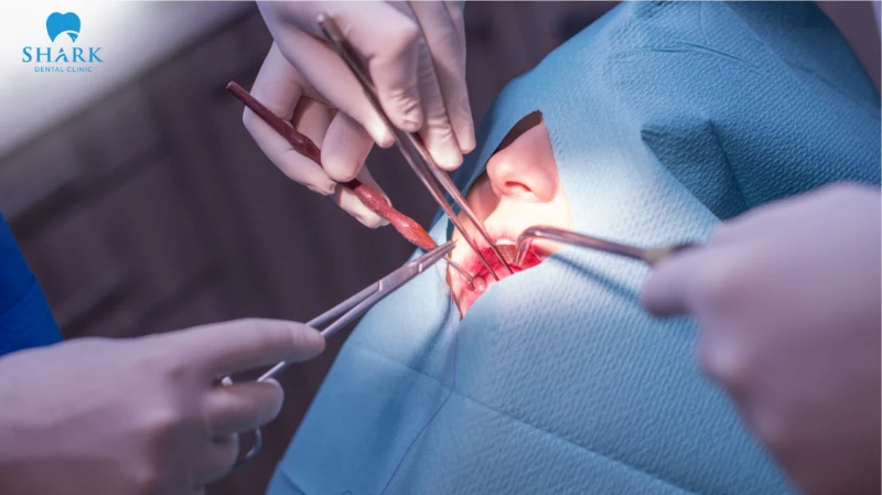 Tất tần tật về nang chân răng và phương pháp điều trị hiệu quả 11 Bác sĩ điều trị nang chân răng